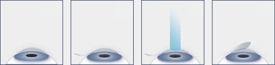 Illustrated diagram of the LASIK process