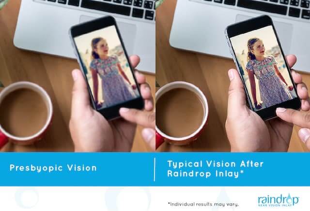 Prysbyopic Vision before and after inlay