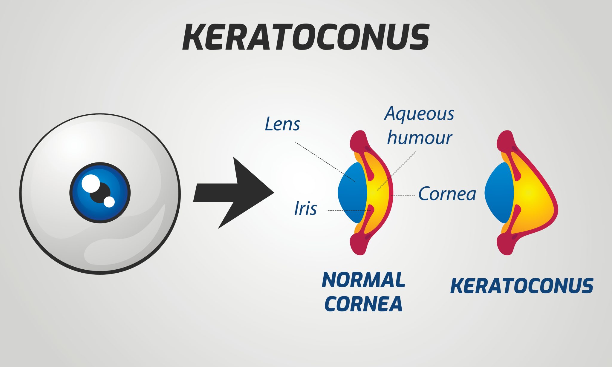 How Does Corneal Collagen Crosslinking Treat Keratoconus? See Clearly
