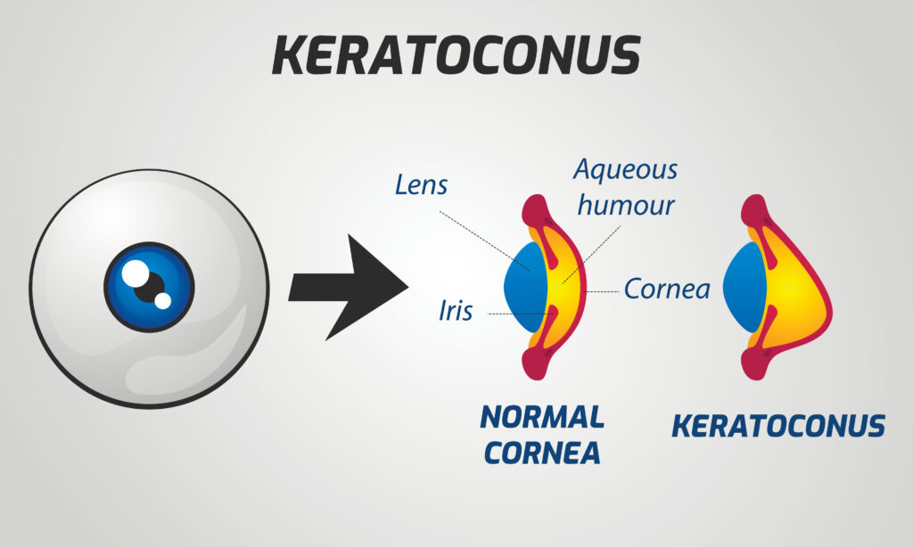 Normal cornea vs Keratoconus