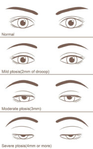 Ptosis chart