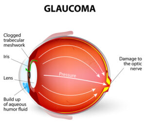 Glaucoma example