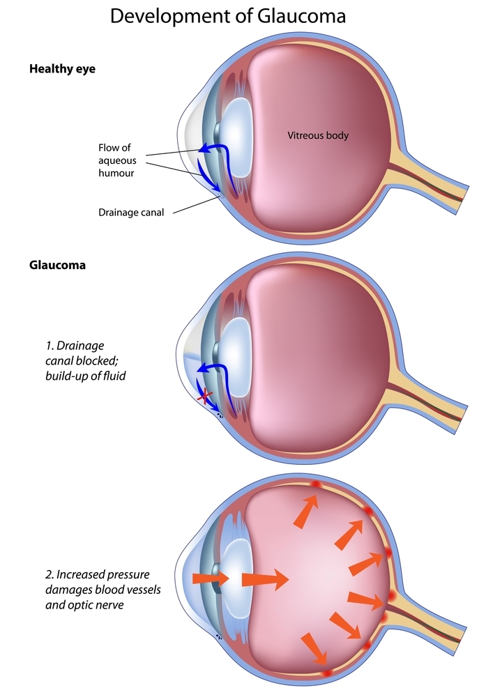 Development of Glaucoma